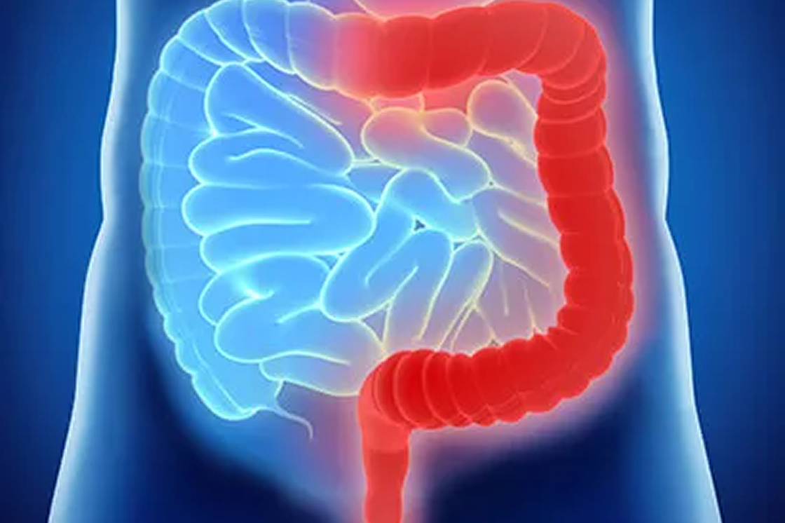 Darstellung der Entzündungsherde im Darm bei Colitis ulcerosa