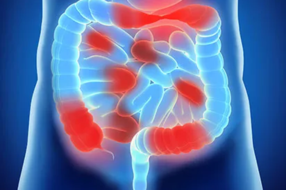 Darstellung der Entzündungsherde im Darm bei Morbus Crohn