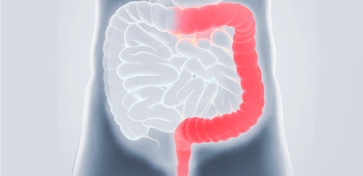 Darstellung der Entzündungsherde im Darm bei Colitis ulcerosa