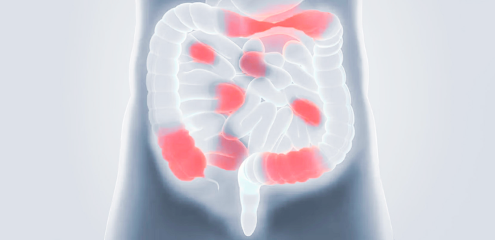 Darstellung der Entzündungsherde im Darm bei Morbus Crohn